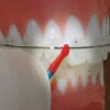 Arch Wire Markers