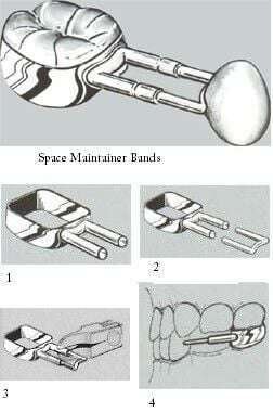 Band-Space-Maintainer-Kit-DSC.jpg Band Space Maintainer Kit