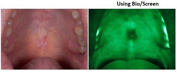 Bio Screen Oral Examination Light - AdDent