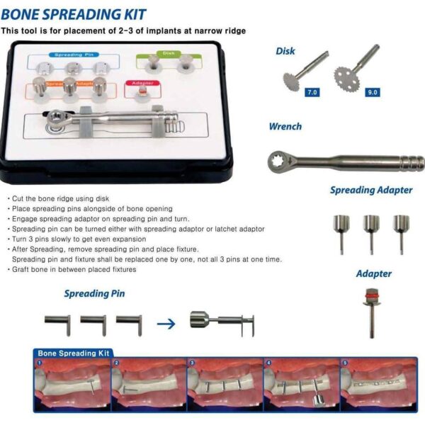 Bone Spreading Kit - Surgident