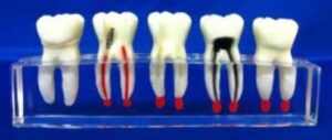 Over-Size Molar Study Model