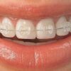 Pure Sapphire Bracket System