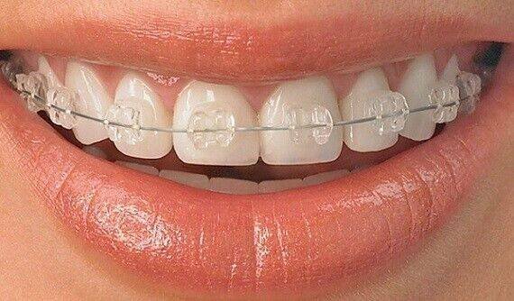 Pure Sapphire Bracket System