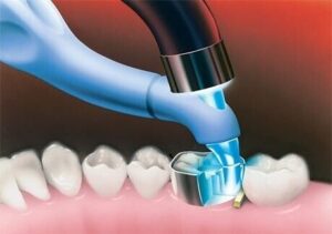 trimax-.jpg Trimax Composite Instrument - AdDent