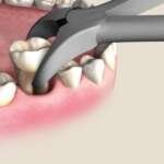 Atraumair 23 Cowhorn Forceps Lower Molar