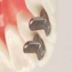 Opti-MIM Bite Guide - Ortho Organizers