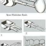 Band Space Maintainer Kit