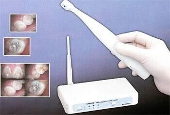 Camrex 192 Wireless Intraoral Camera - Dentamerica