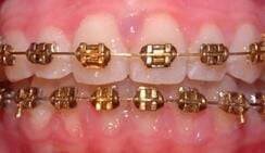Gold Plated NiTi Archwires 24K
