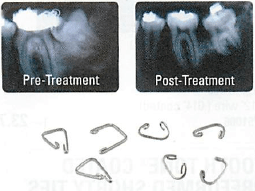 Nickel Titanium Separators